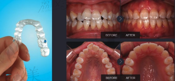 深圳美奧口腔醫(yī)院黃長銀醫(yī)師時代天使隱形矯正<span style=