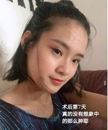 北京壹加壹丁洪如眼综合术后7天