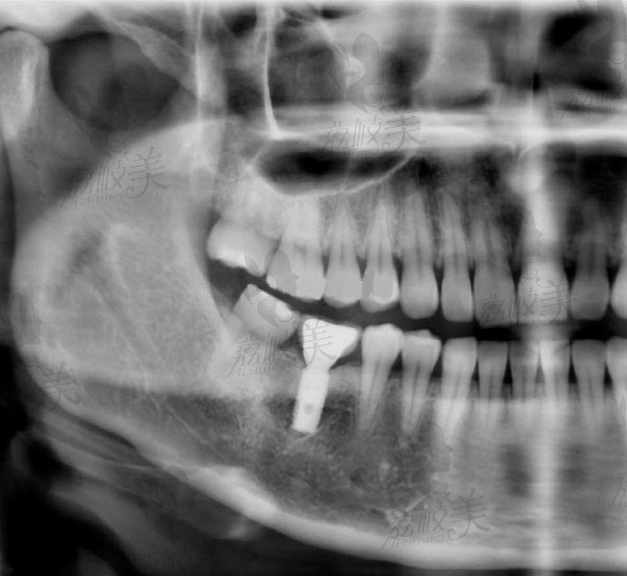 谭震主任10年前种植牙患者复查牙片