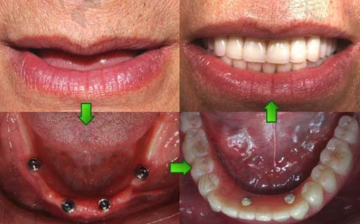 杭州口腔医院城西分院李小凤院长牙齿种植案例分享：种牙后的效果