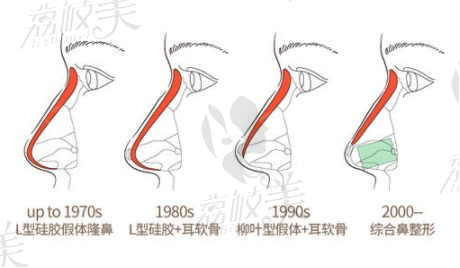北京隆鼻术