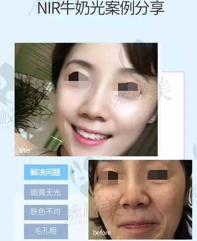 NIR牛奶光美肤对比