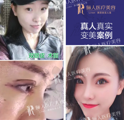 贛州儷人醫(yī)療美容雙眼皮案例