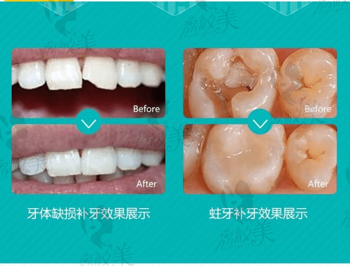 福州市三颗牙口腔门诊部3光固化树脂补牙案例