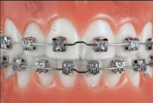 金属托槽矫正牙齿状态