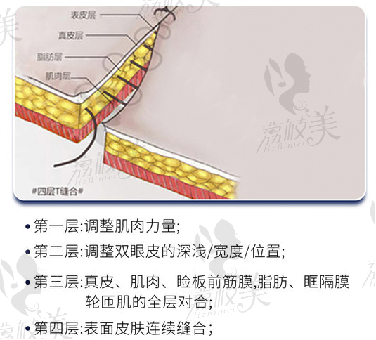 4层缝合法示意图