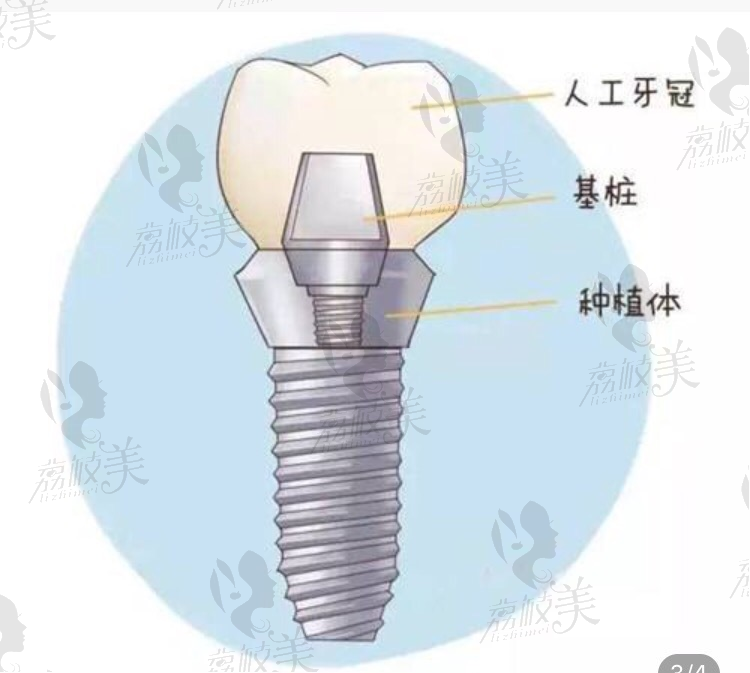 晋江修大夫口腔种植牙