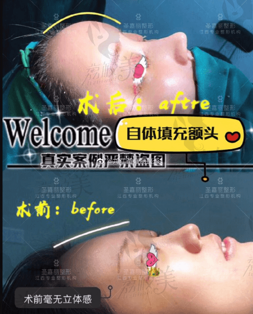 九江圣嘉丽医疗美容自体脂肪填充额头+隆鼻案例