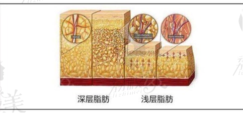 深圳鹏程整形医院 吸脂原理