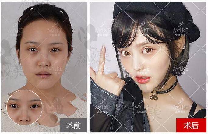 北京美莱时光新生双眼皮修复2.0案例