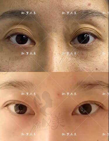 罗杰东医生双眼皮修复案例