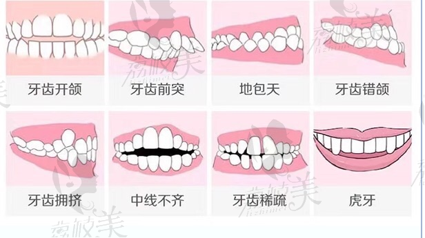 荔枝美牙齿矫正