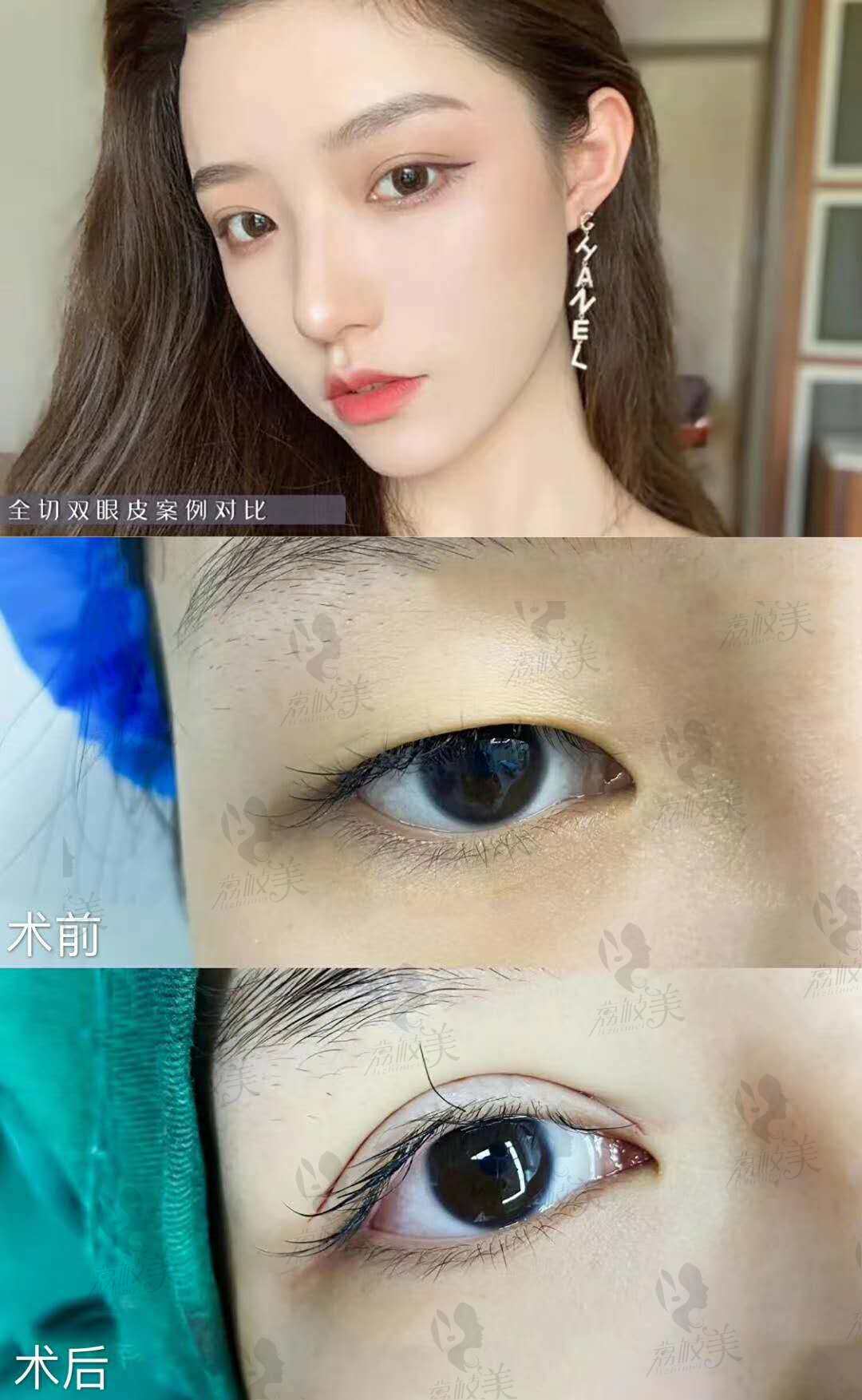刘月更博士 DD数码双眼皮成形术案例分享