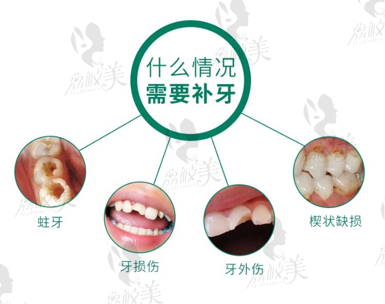 福州贝臣齿科 树脂补牙什么情况补牙