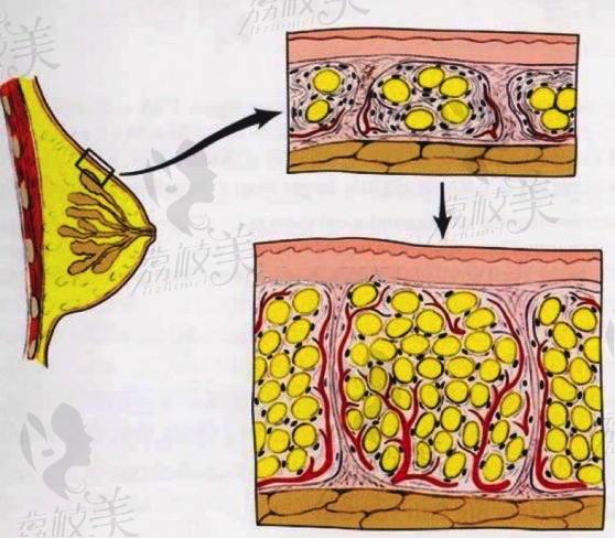 自体脂肪隆胸如何增加存活率？