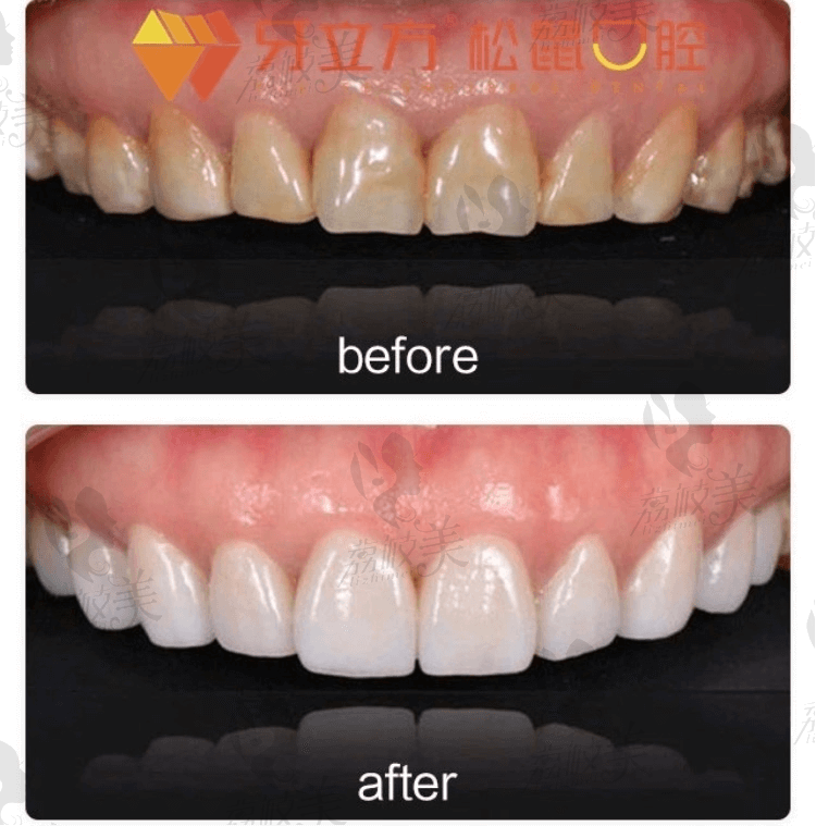 福州松鼠口腔医院牙贴面案例