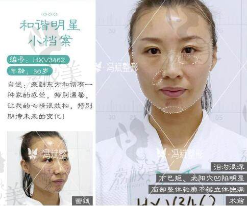 北京东方和谐医疗美容诊所冯斌医生面部脂肪填充案例术前