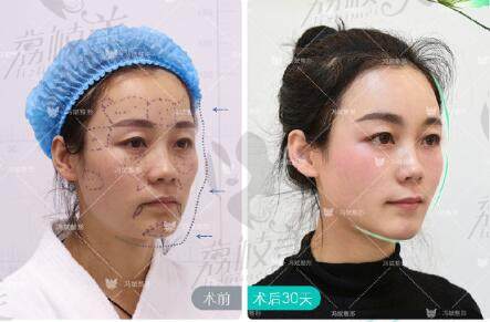 北京东方和谐医疗美容诊所冯斌医生面部脂肪填充案例