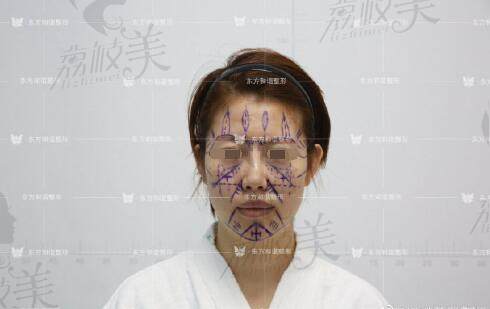 北京东方和谐医疗美容诊所陈斌医生面部脂肪填充术前