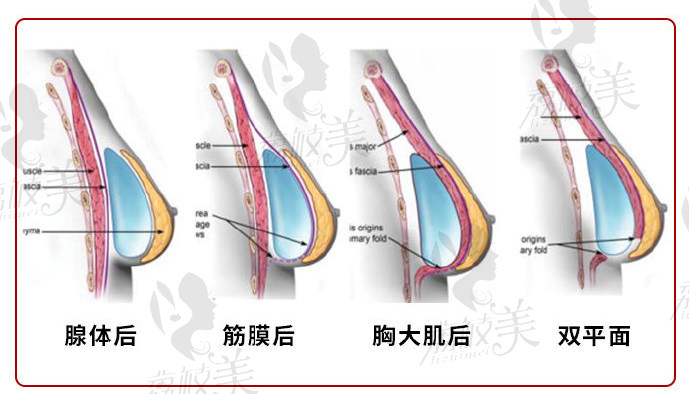 石家庄雅芳亚假体隆胸