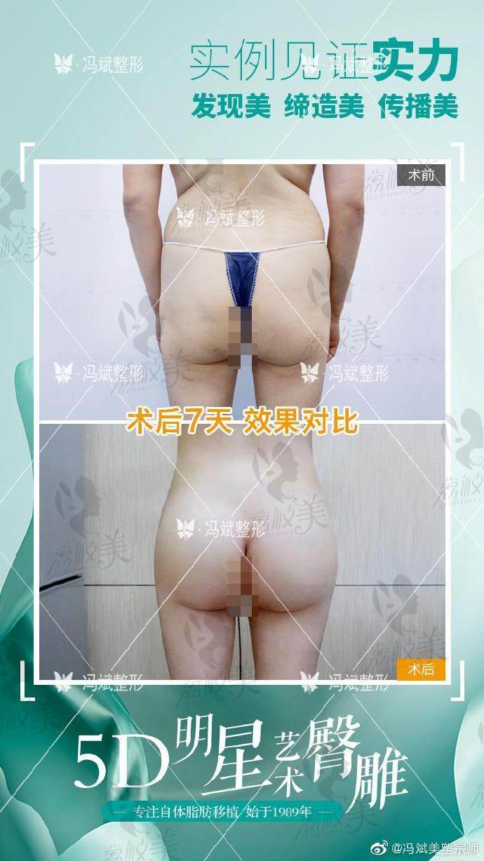北京东方和谐冯斌腰腹吸脂＋脂肪填臀案例