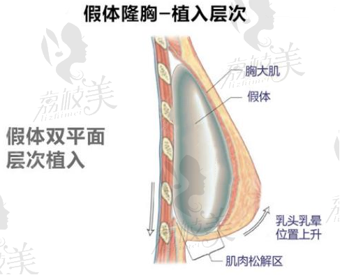 双平面植入