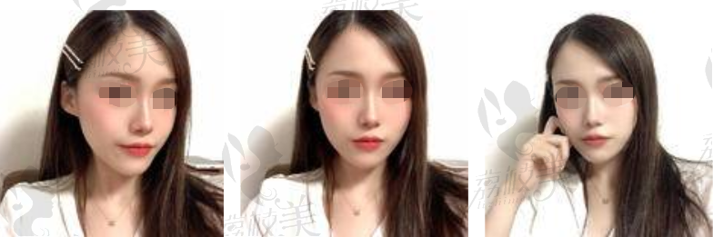 武汉亚韩赵贵庆v-line手术案例