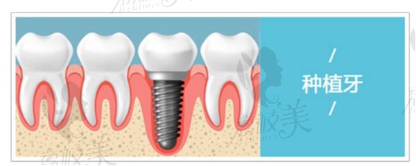 种植牙