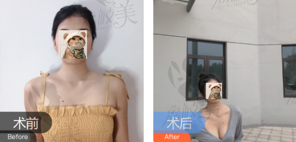 南昌星妍刘记复合隆胸前后效果对比案例