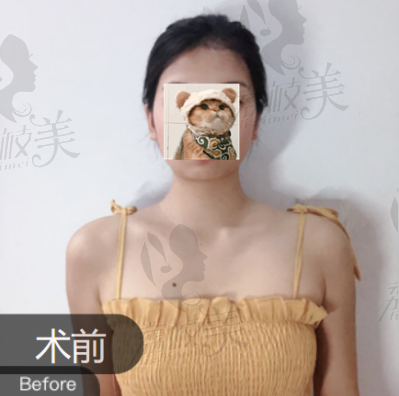 刘记复合隆胸前照片
