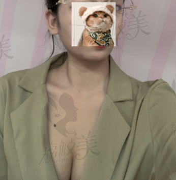 刘记复合隆胸三个月后照片