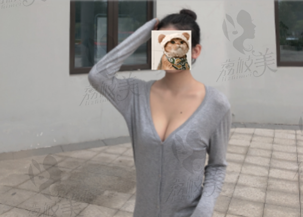 刘记复合隆胸半年后照片