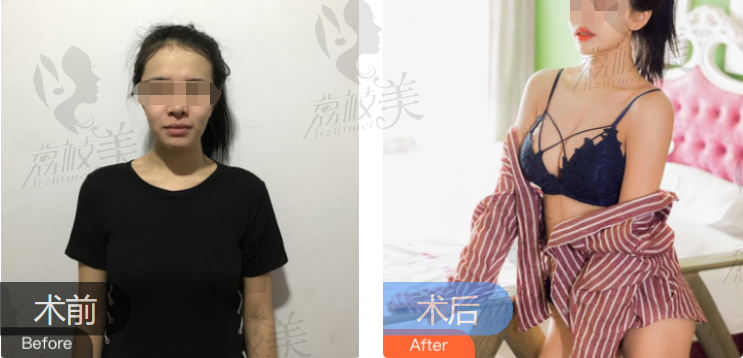 南昌方大戴洪芸丰胸前后效果对比案例