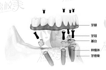 杭州雅莱齿科的姜贵杰院长All-on-4/6即刻负重种植牙