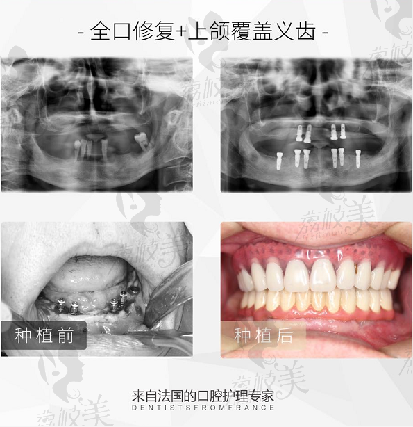 杭州雅莱齿科的姜贵杰院长All-on-4/6即刻负重种植牙案例