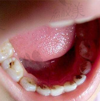 孩子乳牙蛀牙