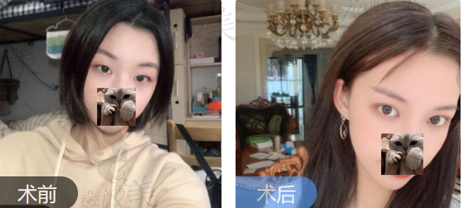 詹领达芬奇定制美眼术前术后效果对比案例