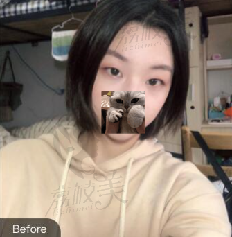 詹领双眼皮手术前照片