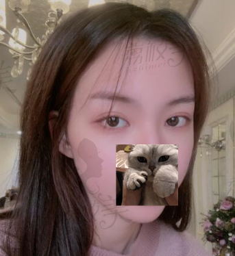 詹领双眼皮手术一个月后照片