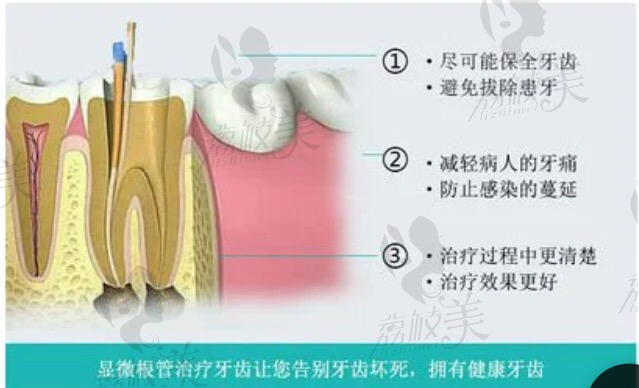 宁德东侨景生口腔门诊显微根管治疗牙齿优势