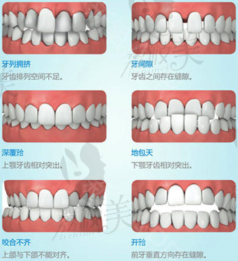 適合金屬托槽矯正的六種情況