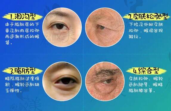 眼袋在临床上主要分为这4类