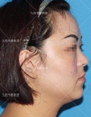 上海九院韦敏颧骨内推长曲线下颌角案例术前侧颜