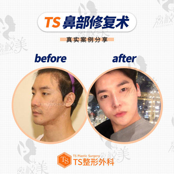 TS整形外科鼻修复案例