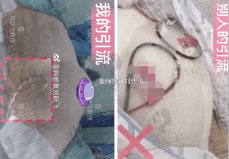 引流出血对比