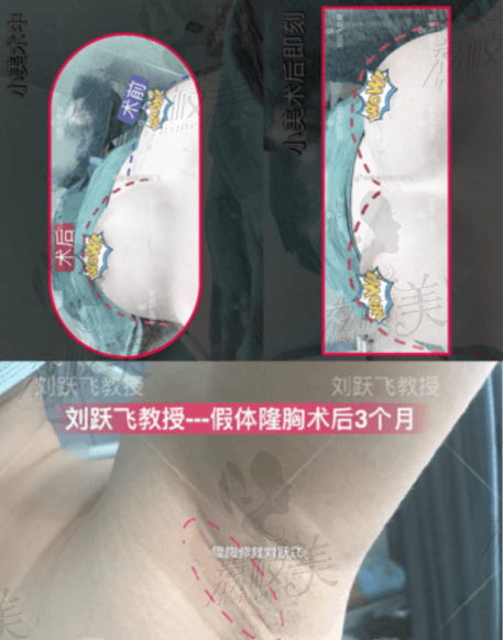 刘院长案例