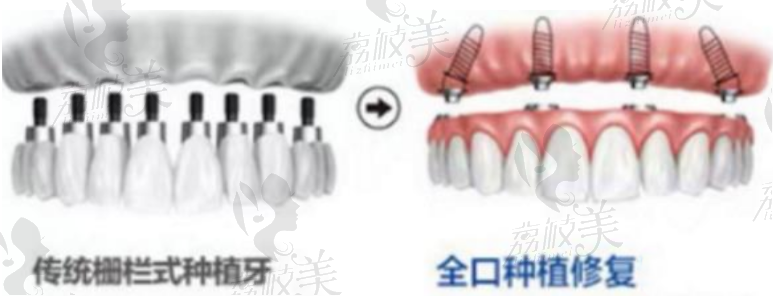 种植牙方式对比