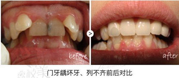 青岛牙博士口腔医院牙齿修复效果案例