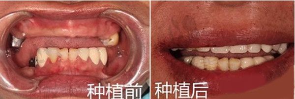 青岛全好口腔医院半口牙种植案例