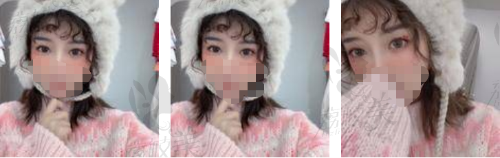 长沙美莱刘欢眼综合案例